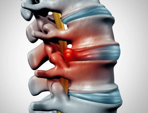 Is Chiropractic Treatment Effective For Bulging Discs?