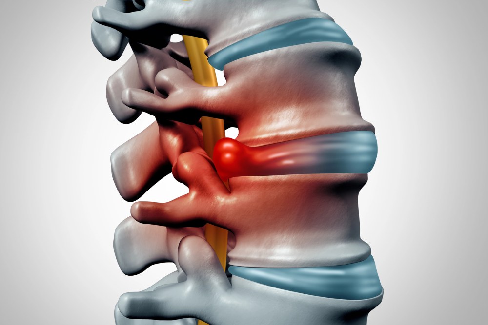 Is Chiropractic Treatment Effective For Bulging Discs?
