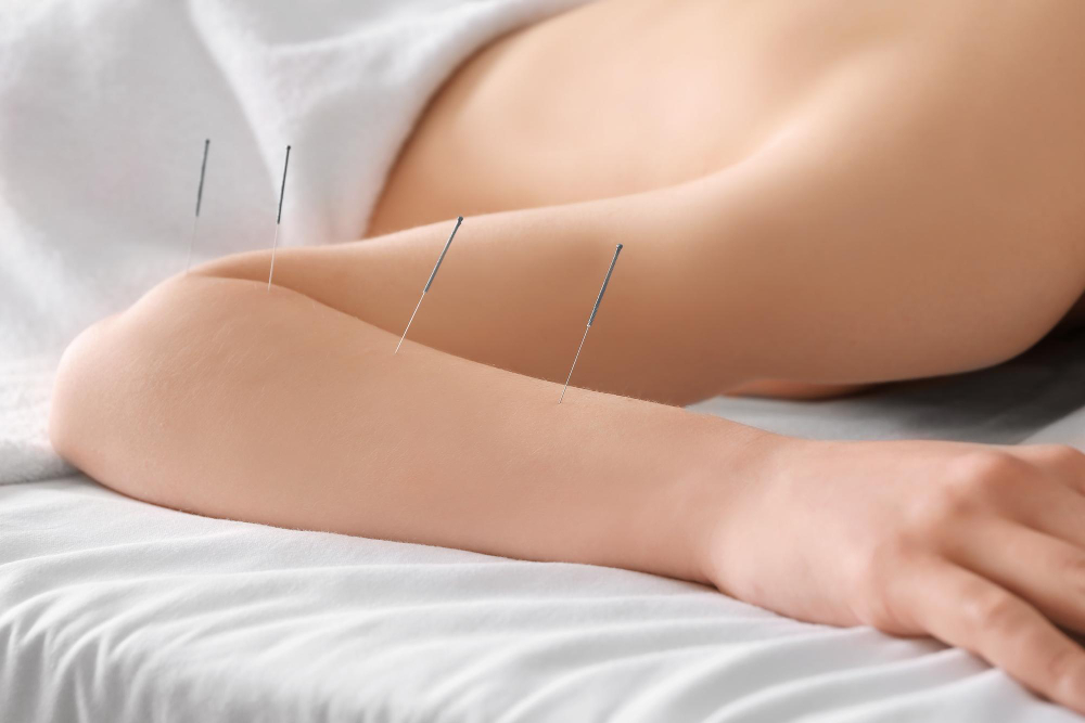 What Not To Do Before Acupuncture What Not To Do Before Acupuncture